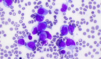AML pCT with KAT6A::CREBBP fusion