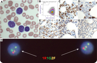 A small B-cell leukemia/lymphoma with weak to negative expression of CD5