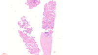 Figure 1 -Bone marrow biopsy (2x)