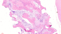 Figure 2 - Bone marrow biopsy (10x)