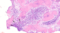 Figure 3 -Bone marrow biopsy (20x)