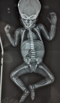 Figure 4 - Infantogram