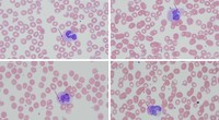 Howell-Jolly Body-like neutrophilic inclusions in heart transplant patient