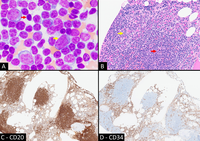 Simultaneous Occurrence of Chronic Lymphocytic Leukemia and High-Grade Therapy-Related Myeloid Neoplasm: Morphologic and Immunohistochemical Features