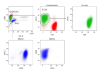 Simultaneous Occurrence of Chronic Lymphocytic Leukemia and High-Grade Therapy-Related Myeloid Neoplasm: Flow Cytometry, Cytogenetics and Molecular Findings