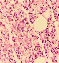 Histoplasma capsulatum in a bone marrow biopsy