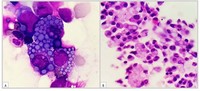 Myeloma- Russell Bodies/Mott cells