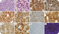 A rare phenotype of peripheral T-cell lymphoma, NOS: coexpression of CD15, CD20, and T follicular helper markers in a DUSP22 case