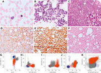 Secondary blastoid plasma cell leukemia: can an old dog learn new tricks?