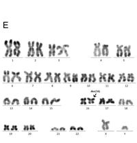 AML with inv(16)/CBFB::MYH11 Mimicking T/Myeloid MPAL by EGIL Criteria 5