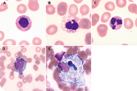 Hematological aspects of colchicine poisoning