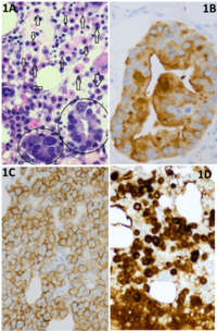 Bone Marrow Biopsy Showing Concurrent Multiple Myeloma and Prostate Carcinoma: Morphologic and Immunohistochemical Features