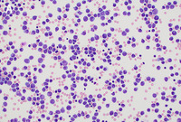 Extramedullary relapse of acute promyelocytic leukemia in cerebrospinal fluid 1