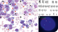 Atypical cytoplasmic inclusions and erythrophagocytosis in acute myeloid leukemia with KMT2A::MLLT3 and U2AF1 mutation