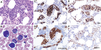 Intrasinusoidal pleomorphic mantle cell lymphoma mimicking intravascular large B-cell lymphoma
