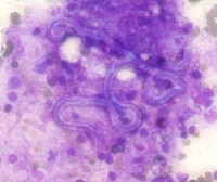 Microfilaria: A Parasite in Bone Marrow