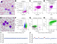 Lineage switch from KMT2A-rearranged congenital B-ALL to AML in an infant: a genomic perspective