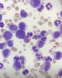 Chronic myeloid leukaemia 1