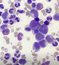 Chronic myeloid leukaemia 2