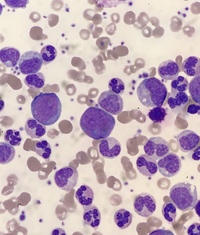 Chronic myeloid leukaemia 3
