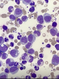Chronic myeloid leukaemia 5