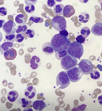 Chronic myeloid leukaemia 2