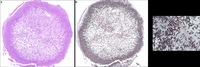 Endobronchial Aspergillosis Following Allogeneic Hematopoietic Cell Transplantation