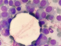 Sheet of Plasmacells with binuclear Plasmacells