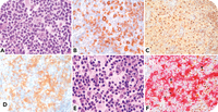 Rare composite of Rosai-Dorfman-Destombes disease and nodular lymphocyte-predominant B-cell (Hodgkin) lymphoma