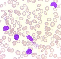Chronic lymphocytic leukemia with flowcytometry 2
