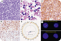 Mantle cell lymphoma with KMT2A rearrangement