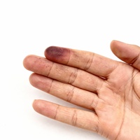 Striking Raynaud’s phenomenon in fluoroquinolone toxicity syndrome: a reversible vasculopathic manifestation