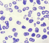 Coarse Basophilic Stippling