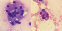 Myelophthisis Due to Metastatic Adenocarcinoma 1