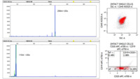 DLBCL- CSF IGH PCR and flow cytometry