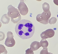 Hypersegmented neutrophil