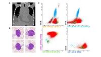 T-lymphoblastic leukemia/lymphoma with bulky mediastinal involvement
