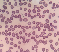 Macro‑ovalocyte 2