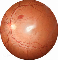 Image 1. Chronic myeloid leukemia with Roth spot