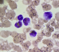Golden-yellow bilirubin crystals within the cytoplasm of neutrophils & monocytes
