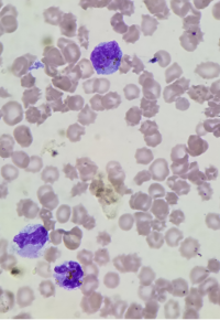 Golden-yellow bilirubin crystals within the cytoplasm of neutrophils and monocytes