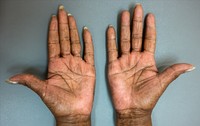 Immunomodulatory drug-associated hyperpigmentation, palms