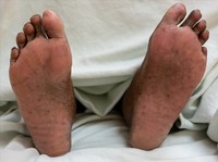 Immunomodulatory drug-associated hyperpigmentation, soles