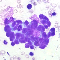 Bone marrow aspirate in metastatic neuroblastoma demonstrating a classic Homer-Wright rosette 1