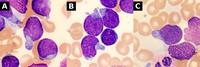 Hand-Mirror Lymphoblasts in T-Cell Acute Lymphoblastic Leukemia 1