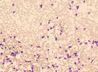 Low-Power View of Hand Mirror Blast Cells in Acute Lymphoblastic Leukemia