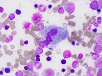 Gaucher's Disease: Aspirate 1