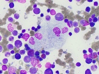 Gaucher's Disease: Aspirate 2