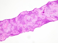 Gaucher's Disease: Trephine H&E 1