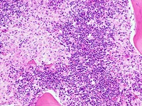 Gaucher's Disease: Trephine H&E 2